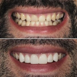 casos clínicos facetas