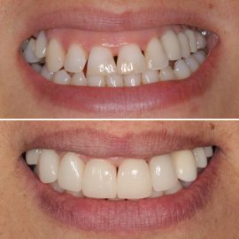 casos clínicos implantes