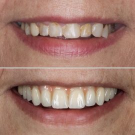 casos clínicos implantes