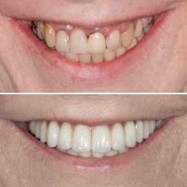 casos clínicos implantes