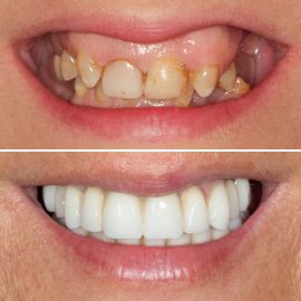 casos clínicos implantes