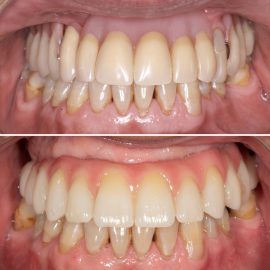 casos clínicos implantes