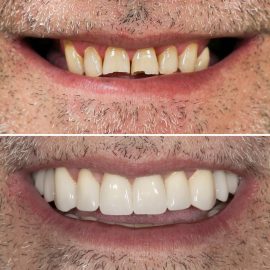 casos clínicos implantes