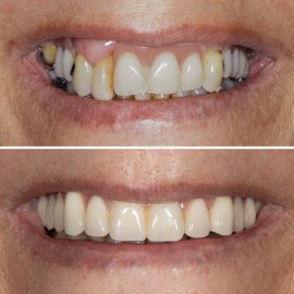 casos clínicos implantes