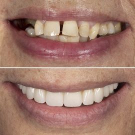 casos clínicos implantes
