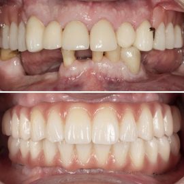 casos clínicos implantes