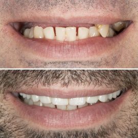 casos clínicos implantes