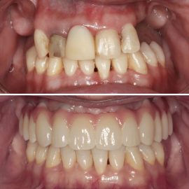 casos clínicos implantes
