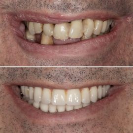 casos clínicos implantes