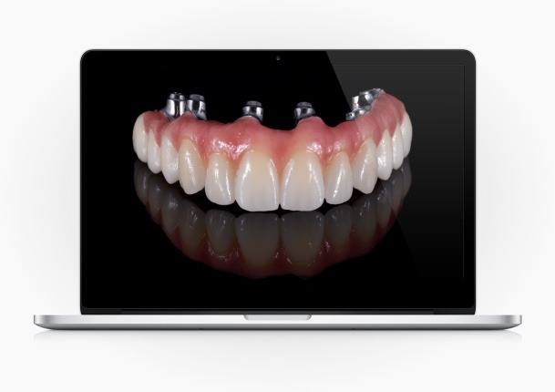 Carga Imediata – Tudo sobre dentes fixos, em menos de 1 dia