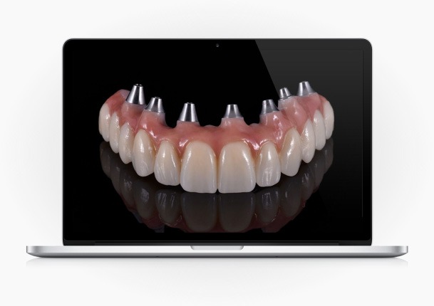 Qual a duração de um tratamento de implantes dentários, com a técnica “Carga Imediata”?