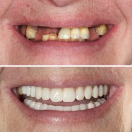 casos clínicos implantes