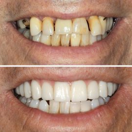 casos clínicos implantes