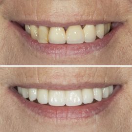 casos clínicos implantes