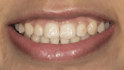 branqueamento dentário