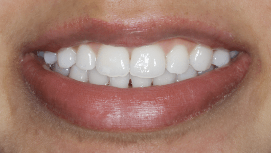 branqueamento dentário