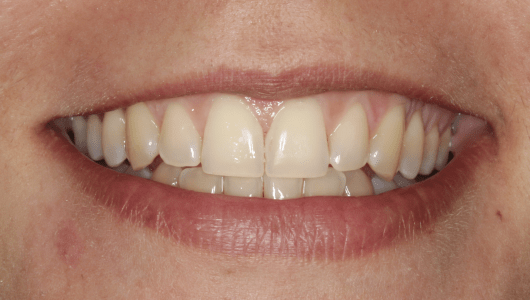 branqueamento dentário