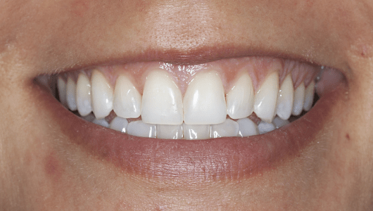 branqueamento dentário