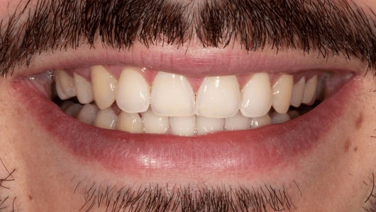 branqueamento dentário