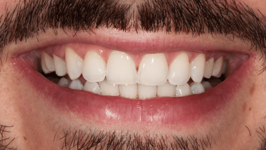 branqueamento dentário