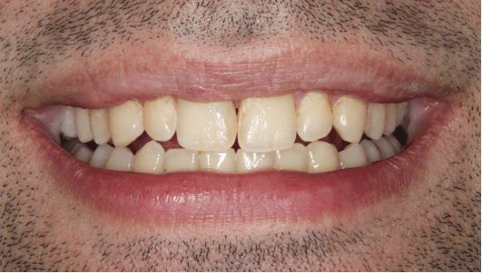 branqueamento dentário