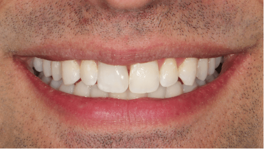 branqueamento dentário