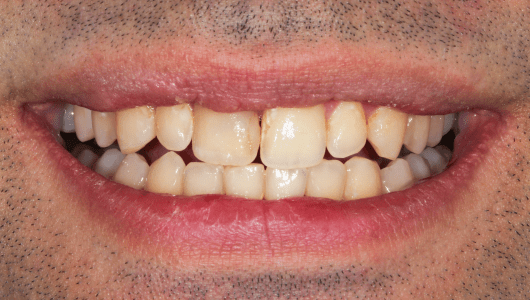 branqueamento dentário