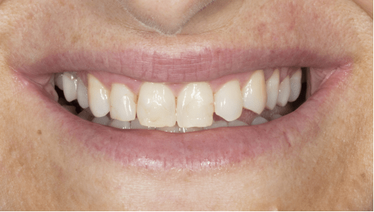 facetas dentárias