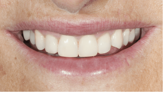 facetas dentárias