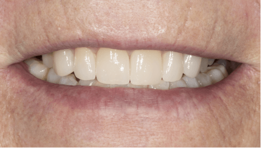 facetas dentárias
