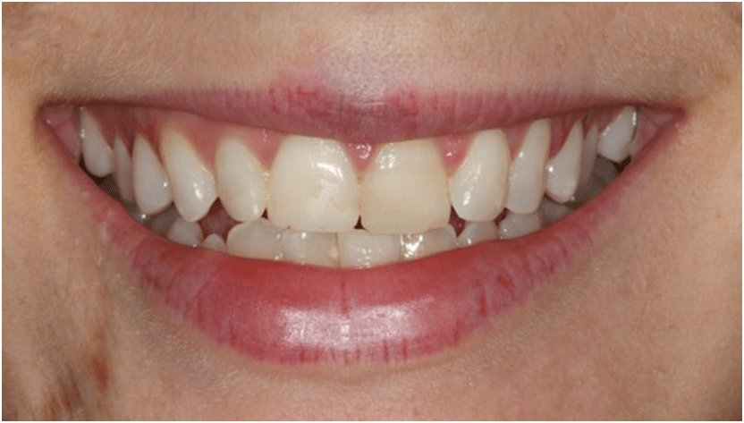 facetas dentárias