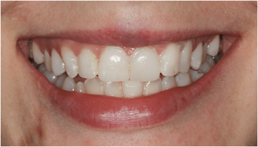 facetas dentárias