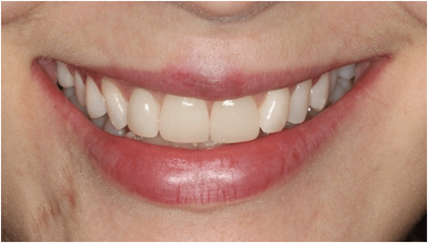 facetas dentárias
