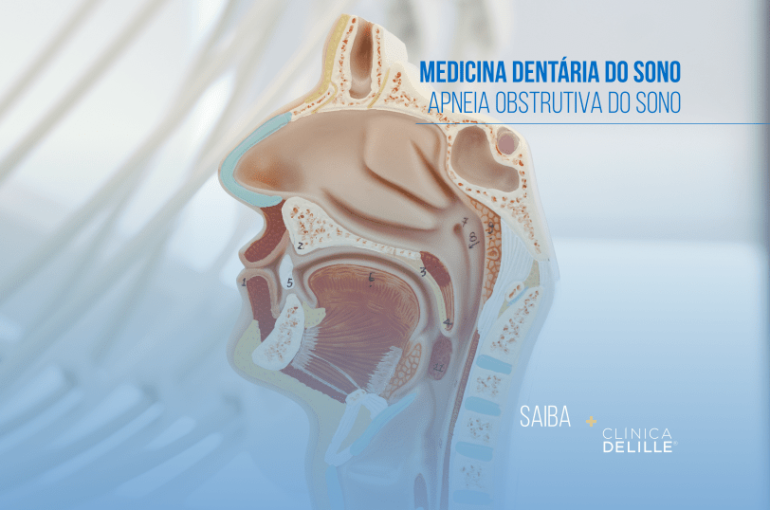 Medicina Dentária do Sono: A apneia obstrutiva do sono