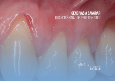Gengivas a sangrar: Quando é sinal de doença periodontal?