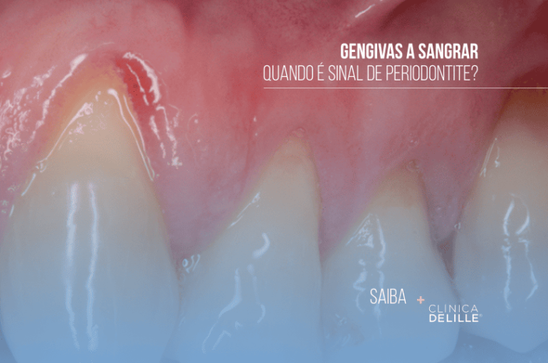 Gengivas a sangrar: Quando é sinal de doença periodontal?