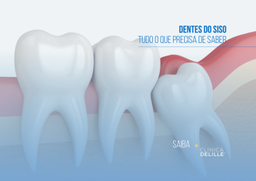 Dentes do Siso: Tudo o que precisa de saber