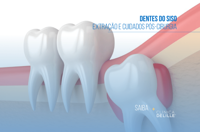 Dentes do Siso: Extração e Cuidados Pós-Cirurgia